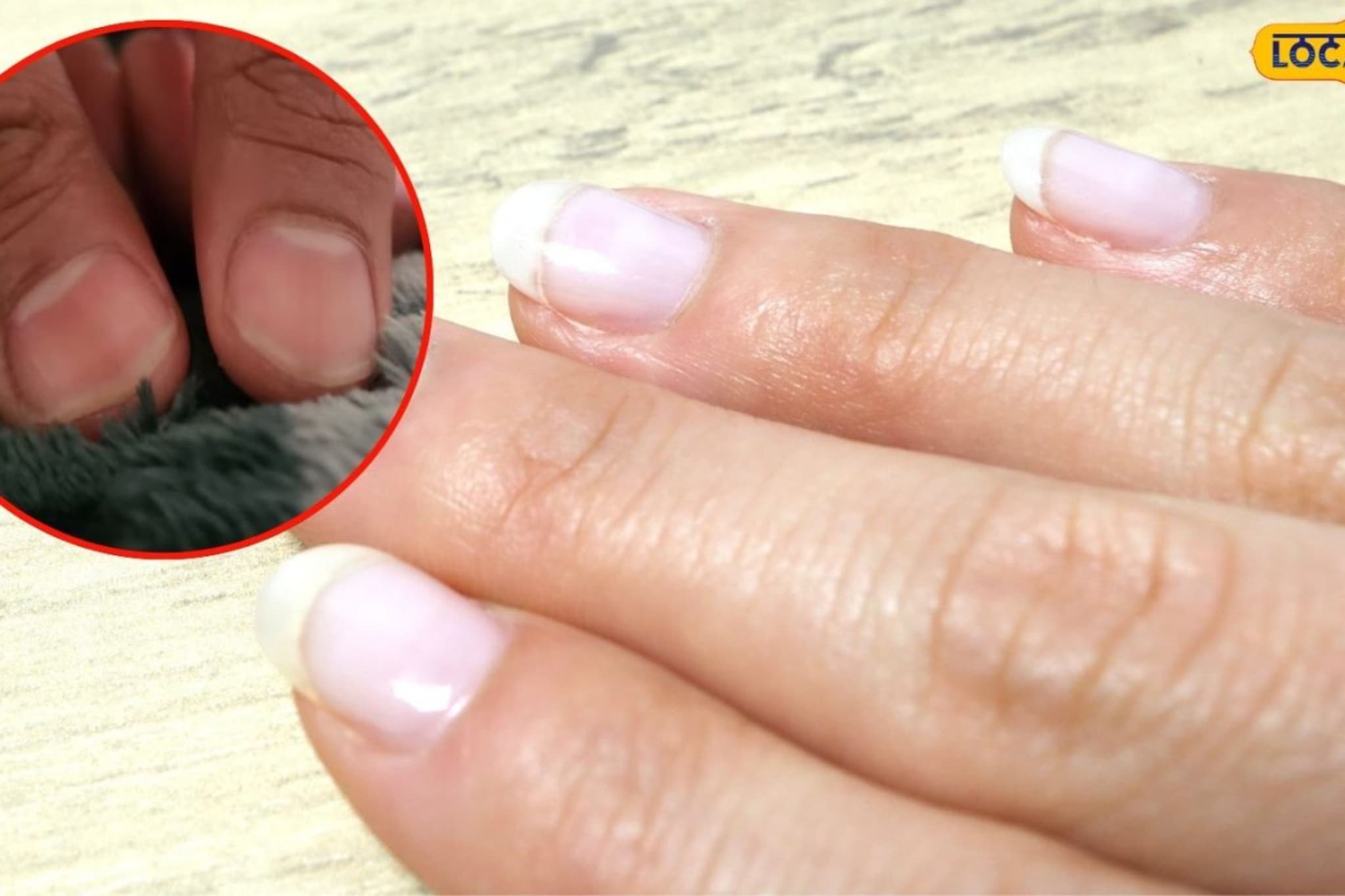 नखांवर पांढरे डाग दिसतात, ते नेमकं काय असतं? याचे काही गंभीर दुष्परिणाम तर नाही?