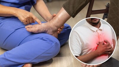 हृदयाचे स्नायू शरीराला आवश्यक असलेला रक्तपुरवठा योग्य पद्धतीनं पंप करण्यात अपयशी ठरतात तेव्हा हार्ट फेल्युअर होते. या स्थितीत हृदयाची पंपिंग प्रक्रिया मंदावण्यासोबतच रक्तप्रवाह संथ होतो आणि शरीरातील रक्तवाहिन्यांवर दाब वाढतो. यामुळं शिरांमधील द्रव पदार्थ बाहेर पडून आसपासच्या उतींमध्ये साचू लागतात. परिणामी शरीराच्या विविध भागांवर सूज दिसू लागते. 