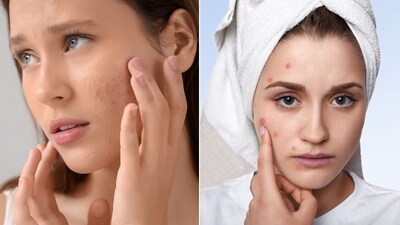 वारंवार पिंपल्स येण्याची कारणे कोणती?