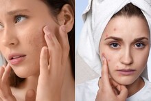 Skin Care Tips : वारंवार चेहऱ्यावर पिंपल्स येतायंत? तुमचं स्किनकेअर आणि आहारातच होतेय चूक..