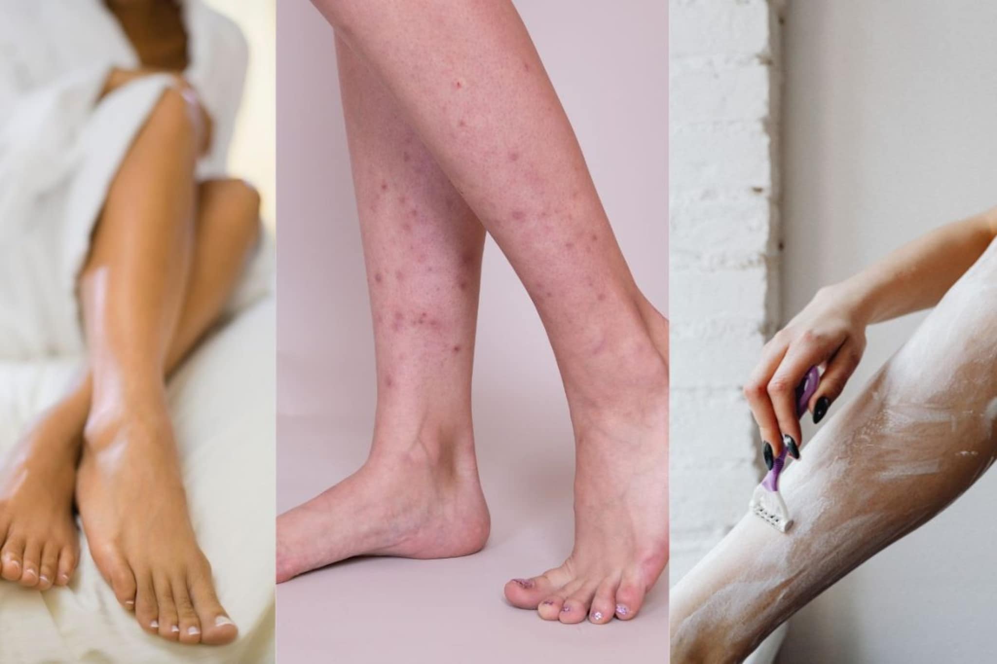 शेव्हिंग-व्हॅक्सिंग केल्यानंतर पायांवर काळे डाग पडतात? 'या' चुकीमुळे होतो 'स्ट्रॉबेरी लेग्ज'चा त्रास