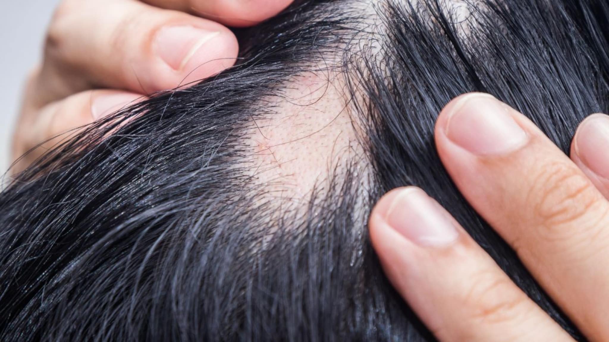 Hair Care : टाळूवर अचानक पडलंय छोटं गोल टक्कल ? घाबरु नका, जाणून घ्या हे नेमकं कशामुळे होतं ? वाचा घरगुती उपायांची यादी 