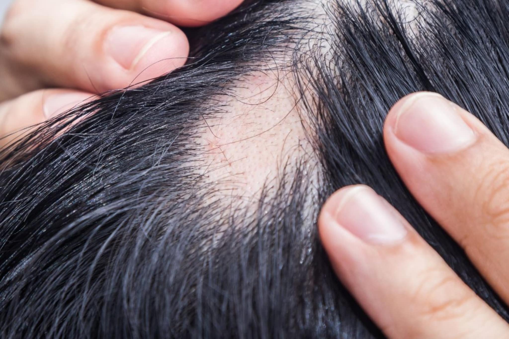 Hair Care : टाळूवर अचानक पडलंय छोटं गोल टक्कल ? घाबरु नका, जाणून घ्या हे नेमकं कशामुळे होतं ? वाचा घरगुती उपायांची यादी 