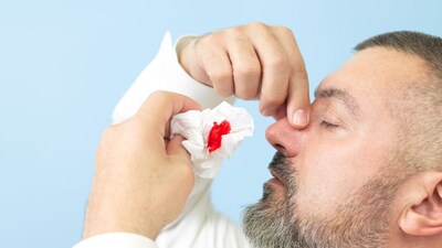 उन्हाळ्यात नाकातून रक्त येणे: रक्तस्राव थांबवण्यासाठी आणि पुन्हा होण्यापासून रोखण्यासाठी प्रथमोपचार