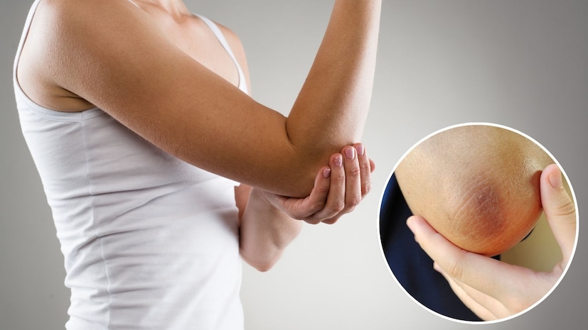 उन्हाळ्यात बऱ्याचदा टॅनिंगचा खूप त्रास होतो. शरीरावर झालेलं टॅनिंग तसं काढता येतं. पण काही भागांवरचं टॅनिंग सहज निघत नाही. तसाच एक भाग म्हणजे हाताचे एल्बो म्हणजेच हाताचे कोपर. कोपरांची त्वचा लवकर काळवंडते. आणि इथले टॅनिंग स्पष्टपणे दिसते. त्यामुळे ते काढणं खूप गरजेचं असतं. उन्हाळ्यात बऱ्याचदा टॅनिंगचा खूप त्रास होतो. शरीरावर झालेलं टॅनिंग तसं काढता येतं. पण काही भागांवरचं टॅनिंग सहज निघत नाही. तसाच एक भाग म्हणजे हाताचे एल्बो म्हणजेच हाताचे कोपर. कोपरांची त्वचा लवकर काळवंडते. आणि इथले टॅनिंग स्पष्टपणे दिसते. त्यामुळे ते काढणं खूप गरजेचं असतं.