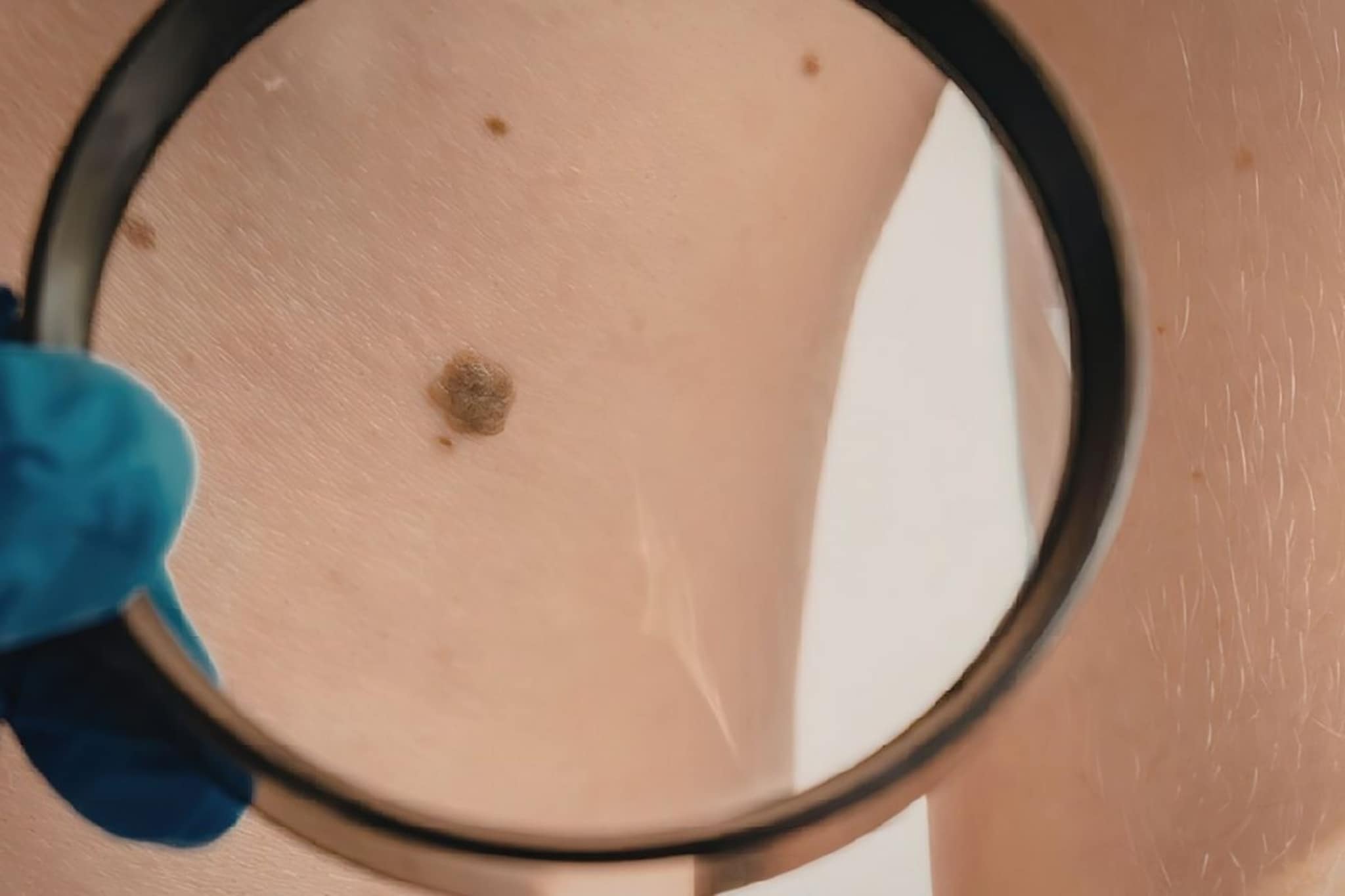 Mole : तुमच्या अंगावरील तिळाचा रंग आणि जागा ठरवते तुमचं भाग्य? जाणून घ्या ज्योतिषशास्त्र काय सांगतं