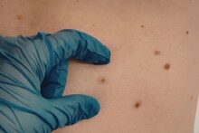 Moles on Body: फक्त काळाच नव्हे! या रंगाचे तीळ असतात लकी; शरीरावर अशा ठिकाणी असणं अतिभाग्यशाली