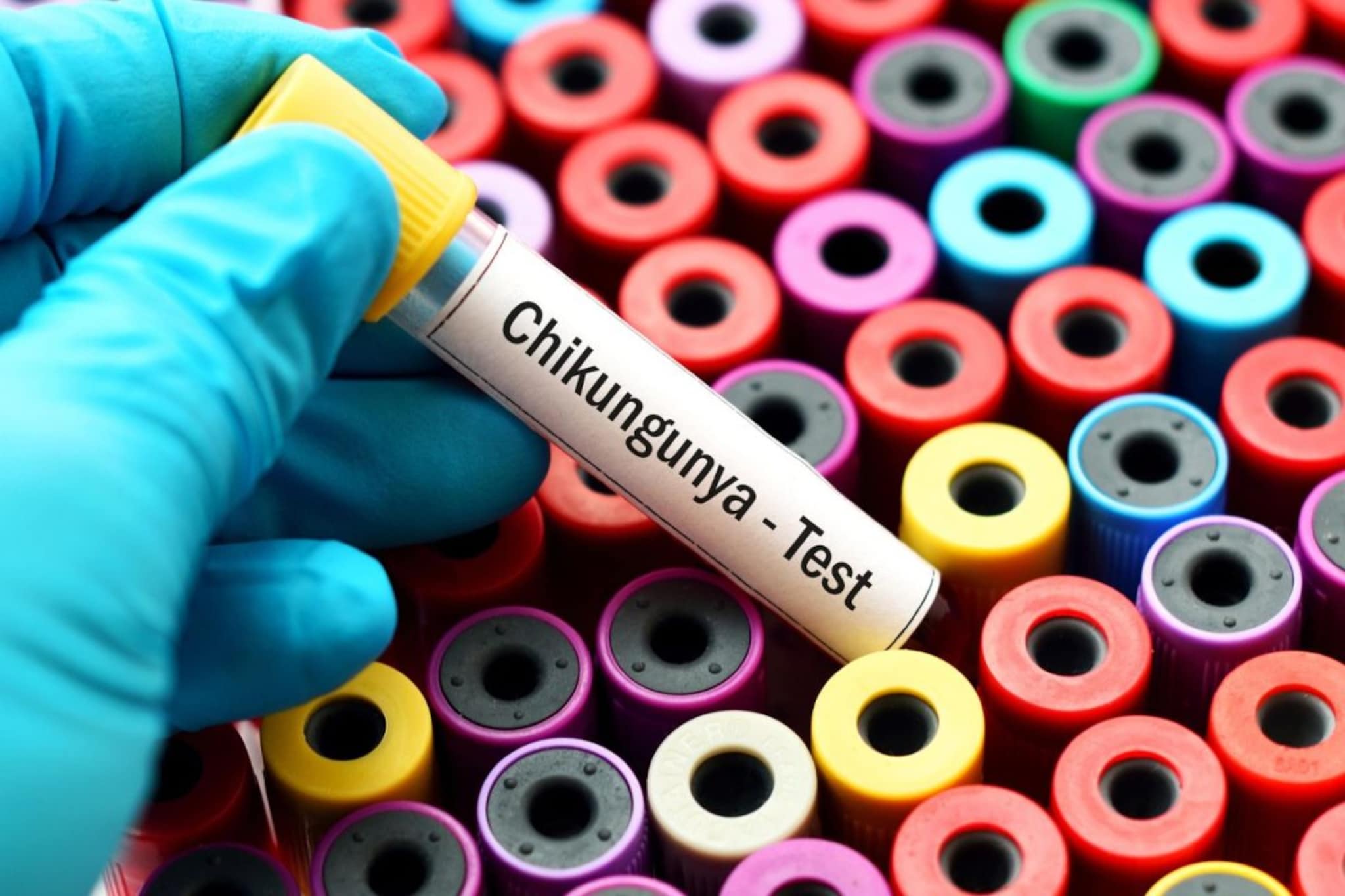 Chikungunya :  सांधेदुखी आणि तापही जाणवतोय ? मिश्र ऋतूमुळे वाढतो गंभीर आजारांचा धोका, वाचा सविस्तर माहिती