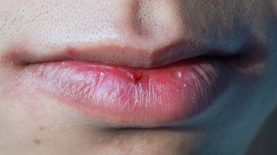 Lip Care Tips: Protect your lips from chapping in changing seasons