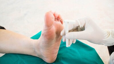 Diabetes Warning: Take Special Care of Your Feet to Prevent Nerve Damage and Loss of Sensation