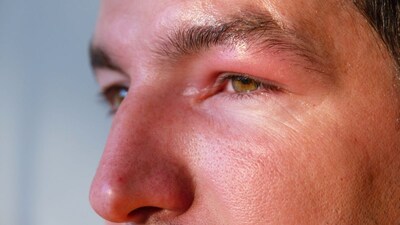 Morning Face Swelling: Causes and Remedies to Reduce Puffiness