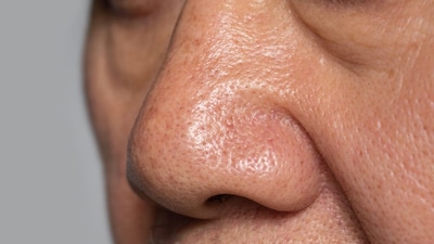 Easy Home Remedies to Remove Whiteheads and Get Glowing Skin