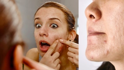 Try Natural Spot Packs For Facial Pimples And Clear Skin Care