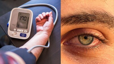 High Blood Pressure Damages Retina: Know The Risks On World Sight Day