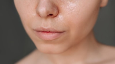 Simple skin care tips to manage and maintain oily skin