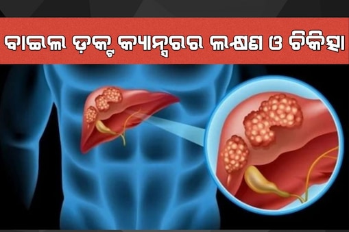 ବାଇଲ ଡ଼କ୍ଟ କ୍ୟାନ୍ସର 
