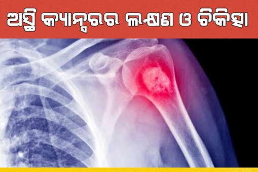 Bone Cancer