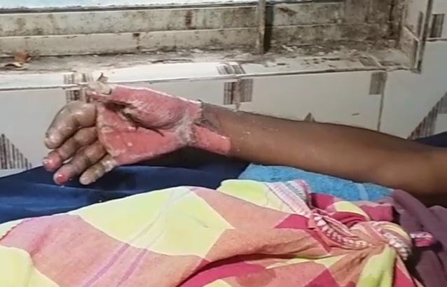  ଯବାନଙ୍କ ହାତ ଗୁରୁତର ଭାବେ ପୋଡ଼ିଯାଇଛି ।