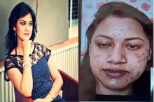 ବ୍ୟୁଟି ପାର୍ଲରରେ ଫେସିଆଲ୍ ଯୋଗୁଁ ଯୁବତୀଙ୍କ ମୁହଁର ତ୍ୱଚା ଜଳିଗଲା, VIDEO ଭାଇରାଲ୍