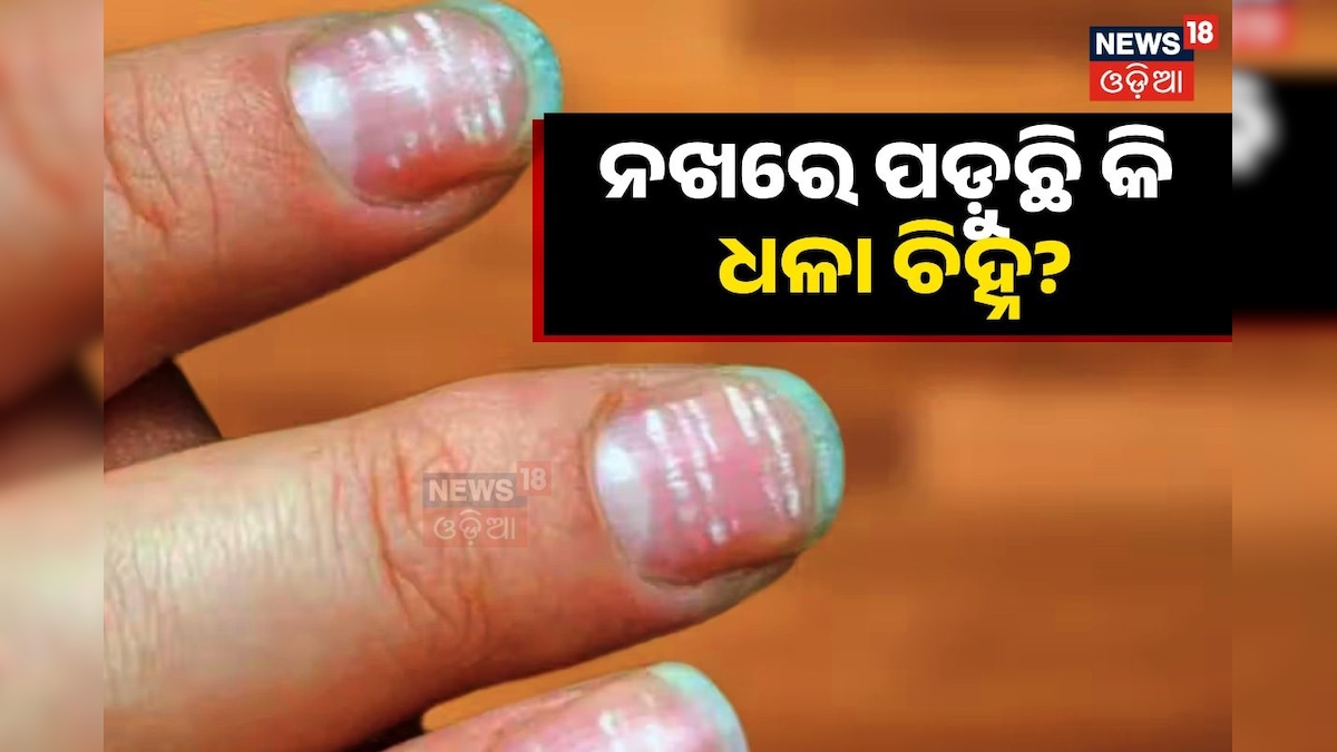 White Spots On Nails ନଖରେ ପଡୁଛି କି ଧଳା ଚିହ୍ନ; ଜାଣନ୍ତୁ ଏହା କେଉଁ ରୋଗର