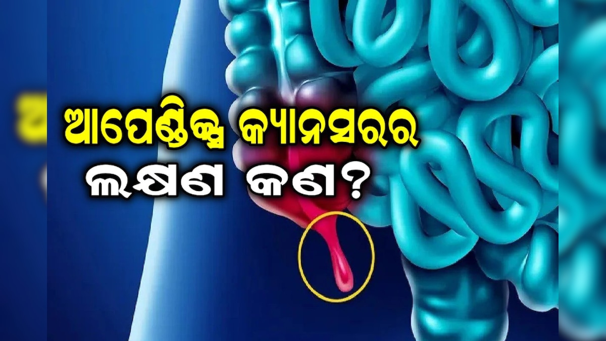 Appendix Cancer: ଆପେଣ୍ଡିକ୍ସ କ୍ୟାନସର ହେଲେ ପେଟ ଦିଏ ଏହି ସଙ୍କେତ! ନ ଜାଣିପାରିଲେ...