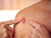 Monkeypox:ਹੁਣ ਦਿੱਲੀ 'ਚ ਮੰਕੀਪੌਕਸ ਦੀ ਦਸਤਕ, 31 ਸਾਲਾ ਨੌਜਵਾਨ ਦੇ ਸਰੀਰ 'ਤੇ ਪਏ ਛਾਲੇ
