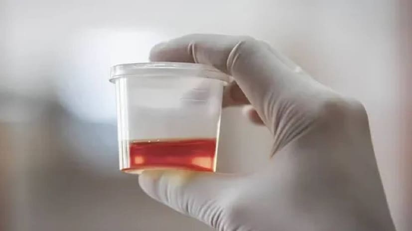 মূত্রে রক্ত-- মূত্রে রক্ত কিডনি বা মূত্রথলির রোগের লক্ষণ। মহিলাদের ক্ষেত্রে, পিরিয়ডের মধ্যবর্তী সময়ে রক্তপাত বা সহবাসের পর রক্তপাত সার্ভিকাল বা এন্ডোমেট্রিয়াল ক্যানসারের লক্ষণ হতে পারে।Image: News18 মূত্রে রক্ত-- মূত্রে রক্ত কিডনি বা মূত্রথলির রোগের লক্ষণ। মহিলাদের ক্ষেত্রে, পিরিয়ডের মধ্যবর্তী সময়ে রক্তপাত বা সহবাসের পর রক্তপাত সার্ভিকাল বা এন্ডোমেট্রিয়াল ক্যানসারের লক্ষণ হতে পারে।Image: News18