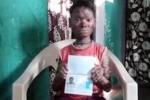 বিরল রোগে আক্রান্ত কিশোরী, ৪৫ দিন অন্তর সাপের মতো খোলস ছাড়ে ! বিরল রোগে আক্রান্ত কিশোরী, ৪৫ দিন অন্তর সাপের মতো খোলস ছাড়ে !