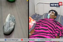 অস্ত্রোপচার করে যুবকের পেট থেকে মিলল ২ কেজি সিমেন্ট ও প্লাস্টার, হতবাক চিকিৎসকেরা অস্ত্রোপচার করে যুবকের পেট থেকে মিলল ২ কেজি সিমেন্ট ও প্লাস্টার, হতবাক চিকিৎসকেরা