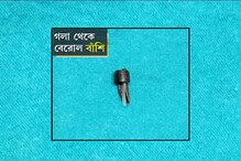 শিশুর ফুসফুসে আটকেছিল বাঁশি, কলকাতা মেডিক্যালে সফল অস্ত্রোপচার শিশুর ফুসফুসে আটকেছিল বাঁশি, কলকাতা মেডিক্যালে সফল অস্ত্রোপচার