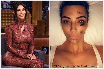 গায়ের বিভিন্ন জায়গায় দগদগে ক্ষত, কঠিন চামড়ার রোগে ভুগছেন এই অভিনেত্রী  !