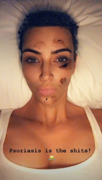 কিম কার্দেশিয়ান নিজেই জানিয়েছেন যে তিনি চামড়ার সমস্যায় ভুগছেন ৷ সোরাইসিস-এ ভুগছেন তিনি ৷ Photo Courtesy: Instagram 