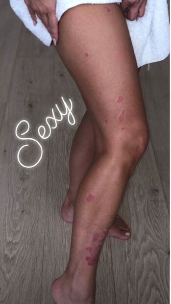 শুধু মুখে নয়, পায়েও কী অবস্থা দেখুন সুন্দরীর ৷ কিন্তু তিনি নিজেকে প্রতিনিয়ত অনুপ্রাণিত করছেন ৷ দেখুন সেক্সি শব্দটি তিনি লিখেছেন নিজের জন্যই ৷ Photo Courtesy: Instagram 