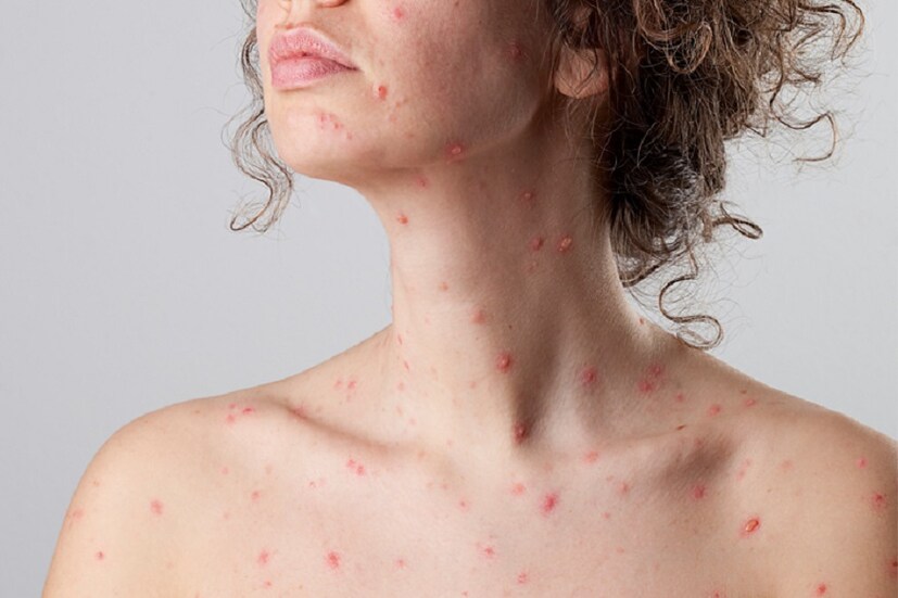 বসন্ত এসে গেছে। বাতাসে মিষ্টি হাওয়া। গাছের পাতায় কৃষ্ণ চূড়ার লুকোচুরি। মন ছুটে যেতে চায় বোলপুরের লাল মাটিতে। পলাশ বনে গা এলিয়ে কাটিয়ে দিতে ইচ্ছে করে সারাটা দিন। কিন্তু এসব কিছু করতে হলে শরীরটাকে তো সুস্থ রাখতে হবে। কারণ এই সময়েই কিন্তু হানা দেয় বসন্ত রোগ। এবং নানা রকম জ্বর। কিন্তু সেই হানা থেকে নিজেকে বাঁচানো যায় সহজেই। শুধু মানতে হবে কতগুলি নিয়ম! photo source collected বসন্ত এসে গেছে। বাতাসে মিষ্টি হাওয়া। গাছের পাতায় কৃষ্ণ চূড়ার লুকোচুরি। মন ছুটে যেতে চায় বোলপুরের লাল মাটিতে। পলাশ বনে গা এলিয়ে কাটিয়ে দিতে ইচ্ছে করে সারাটা দিন। কিন্তু এসব কিছু করতে হলে শরীরটাকে তো সুস্থ রাখতে হবে। কারণ এই সময়েই কিন্তু হানা দেয় বসন্ত রোগ। এবং নানা রকম জ্বর। কিন্তু সেই হানা থেকে নিজেকে বাঁচানো যায় সহজেই। শুধু মানতে হবে কতগুলি নিয়ম! photo source collected