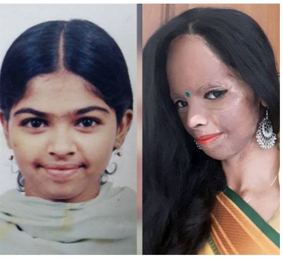 • একটি সাক্ষাৎকারে লক্ষ্মী জানান, ‘‘হাসপাতালে বাবা আসার সঙ্গে সঙ্গে আমি তাঁকে জড়িয়ে ধরেছিলাম ৷ বাবার শার্টের বেশিরভাগটাই পুড়ে যায় ৷ যখন আমি বাড়ি ফিরি, বাড়ির সমস্ত আয়না সরিয়ে দেওয়া হয়েছিল ৷’’ • একটি সাক্ষাৎকারে লক্ষ্মী জানান, ‘‘হাসপাতালে বাবা আসার সঙ্গে সঙ্গে আমি তাঁকে জড়িয়ে ধরেছিলাম ৷ বাবার শার্টের বেশিরভাগটাই পুড়ে যায় ৷ যখন আমি বাড়ি ফিরি, বাড়ির সমস্ত আয়না সরিয়ে দেওয়া হয়েছিল ৷’’
