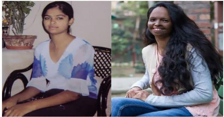 • ‘‘এরপর যখন একদিন আমি নিজের মুখ আয়নায় দেখলাম, তখন আত্মহ্ত্যা করব ঠিক করি ৷ কিন্তু আমার পরিবার আমাকে দারুণ সাপোর্ট করেছিল ৷ আস্তে আস্তে মনের জোর ফিরে পাই ৷ আমার মুখ ঘষে-মেজে গিয়েছিল, কিন্তু ভিতর থেকে আমি সতেজ আর দৃঢ় হয়ে উঠেছি ৷’’ • ‘‘এরপর যখন একদিন আমি নিজের মুখ আয়নায় দেখলাম, তখন আত্মহ্ত্যা করব ঠিক করি ৷ কিন্তু আমার পরিবার আমাকে দারুণ সাপোর্ট করেছিল ৷ আস্তে আস্তে মনের জোর ফিরে পাই ৷ আমার মুখ ঘষে-মেজে গিয়েছিল, কিন্তু ভিতর থেকে আমি সতেজ আর দৃঢ় হয়ে উঠেছি ৷’’