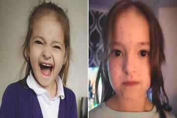 স্কুল না যাওয়ার বাহানা, সারা গায়ে চিকেন পক্স এঁকে ইন্টারনেটে ভাইরাল খুদে স্কুল না যাওয়ার বাহানা, সারা গায়ে চিকেন পক্স এঁকে ইন্টারনেটে ভাইরাল খুদে