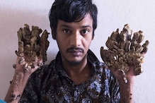 আর সহ্য হচ্ছে না! দু'হাত কেটে ফেলে যন্ত্রণামুক্তি চাইছেন বাংলাদেশি ট্রি-ম্যান আর সহ্য হচ্ছে না! দু'হাত কেটে ফেলে যন্ত্রণামুক্তি চাইছেন বাংলাদেশি ট্রি-ম্যান