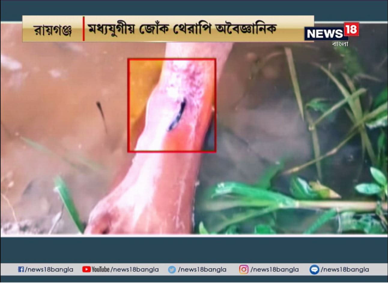 ঘুম থেকে ওঠার পরই দুই পায়ে অসহ্য যন্ত্রণা শুরু হয় রায়গঞ্জের মহারাজা গ্রামের বাসিন্দা সায়ন সরকারের। বিছানা থেকে নেমেই এক দৌড়ে বাড়ির পাশের পানা পুকুরে। জলে নেমে একটু লাফালাফি করার পরই পায়ের ক্ষতস্থান আঁকড়ে ধরে জোঁকের দল। দশ-বারোটা মিনিট রক্তচোষাদের দাপাদাপির পর কমে অসহ্য যন্ত্রণা। এরপর বাড়ি ফিরে মশলামুড়ির ভ্যান নিয়ে বেড়িয়ে পড়া পেটের টানে। ঘুম থেকে ওঠার পরই দুই পায়ে অসহ্য যন্ত্রণা শুরু হয় রায়গঞ্জের মহারাজা গ্রামের বাসিন্দা সায়ন সরকারের। বিছানা থেকে নেমেই এক দৌড়ে বাড়ির পাশের পানা পুকুরে। জলে নেমে একটু লাফালাফি করার পরই পায়ের ক্ষতস্থান আঁকড়ে ধরে জোঁকের দল। দশ-বারোটা মিনিট রক্তচোষাদের দাপাদাপির পর কমে অসহ্য যন্ত্রণা। এরপর বাড়ি ফিরে মশলামুড়ির ভ্যান নিয়ে বেড়িয়ে পড়া পেটের টানে।