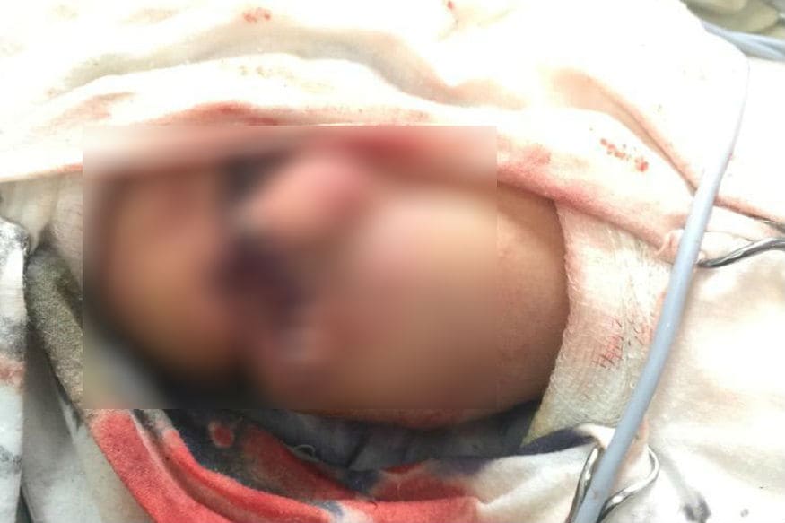 • তবে চিকিৎসকরা জানাচ্ছেন, শিশুটিকে অজ্ঞান করার কাজটিই ছিল সবচেয়ে কঠিন ৷ ডোজের সামান্য একটু এদিক ওদিক হলে অবস্থা আরও জটিল হওয়ার সম্ভাবনা ছিল ৷ • তবে চিকিৎসকরা জানাচ্ছেন, শিশুটিকে অজ্ঞান করার কাজটিই ছিল সবচেয়ে কঠিন ৷ ডোজের সামান্য একটু এদিক ওদিক হলে অবস্থা আরও জটিল হওয়ার সম্ভাবনা ছিল ৷
