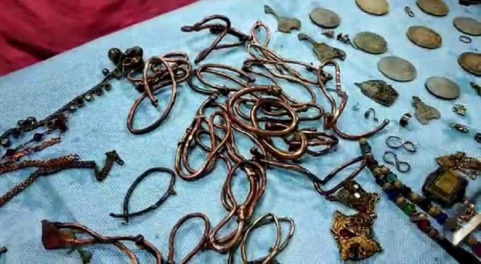 সোনা, রূপো, তামা, ইমিটিশন সব মিলিয়ে উদ্ধার হওয়া গয়নার পরিমাণ প্রায় দু’কেজি। উদ্ধার হয়েছে প্রায় ৬০টিরও বেশি কয়েন। চিকিৎসক সিদ্ধার্থ বিশ্বাসের মতে মাটির দলার সঙ্গে এই কয়েনগুলি খেয়ে থাকতে পারেন রোগী। সোনা, রূপো, তামা, ইমিটিশন সব মিলিয়ে উদ্ধার হওয়া গয়নার পরিমাণ প্রায় দু’কেজি। উদ্ধার হয়েছে প্রায় ৬০টিরও বেশি কয়েন। চিকিৎসক সিদ্ধার্থ বিশ্বাসের মতে মাটির দলার সঙ্গে এই কয়েনগুলি খেয়ে থাকতে পারেন রোগী।