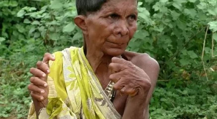 অসম্ভব দরিদ্র পরিবারে জন্মেছেন তিনি ৷ নাম কুরাম নায়েক ৷ বয়স ৬৩ ৷ কিন্তু টাকার অভাবে তাঁর শারীরিক অস্বাভাবিকতার চিকিৎসা করাতে পারেননি তিনি ৷ Photo- Picture: SWNS অসম্ভব দরিদ্র পরিবারে জন্মেছেন তিনি ৷ নাম কুরাম নায়েক ৷ বয়স ৬৩ ৷ কিন্তু টাকার অভাবে তাঁর শারীরিক অস্বাভাবিকতার চিকিৎসা করাতে পারেননি তিনি ৷ Photo- Picture: SWNS