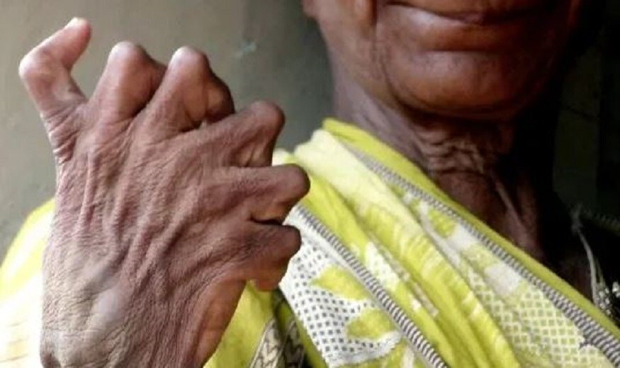 এই ভদ্রমহিলা ওড়িশার গঞ্জাম জেলার বাসিন্দা ৷ শারীরিক এই অস্বাভাবিকতার জন্য পুরো সমাজে ব্রাত্য তিনি ৷ প্রতিবেশীরা কেউই তাঁর সঙ্গে মেশে না ৷ Photo- Picture: SWNS এই ভদ্রমহিলা ওড়িশার গঞ্জাম জেলার বাসিন্দা ৷ শারীরিক এই অস্বাভাবিকতার জন্য পুরো সমাজে ব্রাত্য তিনি ৷ প্রতিবেশীরা কেউই তাঁর সঙ্গে মেশে না ৷ Photo- Picture: SWNS