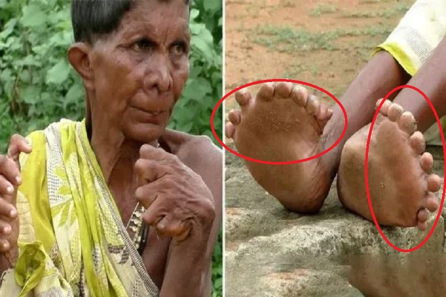 হাতে ১২ টি আঙুল আর পায়ের পাতায় ২০ টি করে আঙুল ৷ এই নিয়ে জন্মেছেন এই ভদ্রমহিলা ৷ আর এই ‘অপরাধে’ তাঁকে গোটা সমাজ ব্রাত্য করে রেখেছে৷ Photo- Picture: SWNS হাতে ১২ টি আঙুল আর পায়ের পাতায় ২০ টি করে আঙুল ৷ এই নিয়ে জন্মেছেন এই ভদ্রমহিলা ৷ আর এই ‘অপরাধে’ তাঁকে গোটা সমাজ ব্রাত্য করে রেখেছে৷ Photo- Picture: SWNS