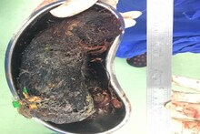 পেটের ভিতরে চুল ও শ্যাম্পুর বিশাল বল, অপারেশন টেবিলে হতবাক চিকিৎসকেরা