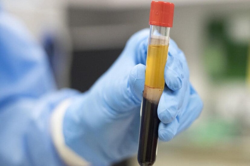 কলকাতায় প্লাজমা থেরাপিতে আশার আলো। ১০ জনের ক্লিনিক্যাল ট্রায়াল ইতিবাচক হয়েছে বলে দাবি গবেষকদের। কলকাতায় প্লাজমা থেরাপির ক্লিনিক্যাল ট্রায়াল শুরু করেছে ইন্ডিয়ান ইনস্টিটিউট অব কেমিক্যাল বায়োলজি। গবেষকদের দাবি, এখনও পর্যন্ত ফল আশাব্যাঞ্জক। CSIR ও স্বাস্থ্য দফতরে জমা পড়েছে ক্লিনিক্যাল ট্রায়ালের রিপোর্ট।