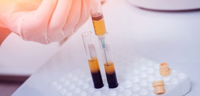 করোনায় আশার আলো। কলকাতায় প্লাজমা থেরাপিতে সুফল। এ শহরে ক্লিনিক্যাল ট্রায়াল শুরু করে ইন্ডিয়ান ইনস্টিটিউট অব কেমিক্যাল বায়োলজি। গবেষকদের দাবি, যাঁদের প্লাজমা দেওয়া হয়েছে তাঁদের বেশিরভাগই উপকৃত হয়েছেন। কারও মধ্যে কোনও বিরূপ প্রভাব পড়েনি। 