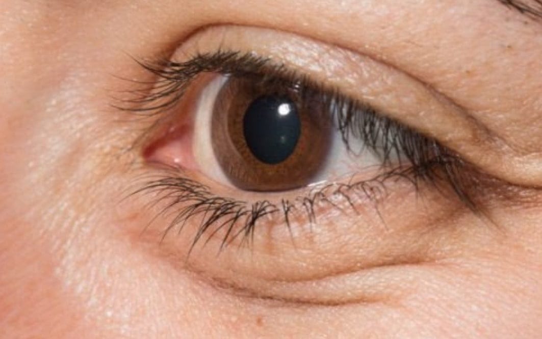 চোখের আশেপাশের অংশ ফুলে যাওয়া - Eye Puffiness অর্থাৎ চোখের নিচের ও পাশের দিকের অংশ ফুলে গেলে বা কুঁচকে গেলে সচেতন হবে। দিনের পর দিন এই একই পরিস্থিতি থাকলে বুঝতে হবে কিডনি মূত্রের মাধ্যমে অনেক প্রোটিন ক্ষয় করছে। চোখের আশেপাশের অংশ ফুলে যাওয়া - Eye Puffiness অর্থাৎ চোখের নিচের ও পাশের দিকের অংশ ফুলে গেলে বা কুঁচকে গেলে সচেতন হবে। দিনের পর দিন এই একই পরিস্থিতি থাকলে বুঝতে হবে কিডনি মূত্রের মাধ্যমে অনেক প্রোটিন ক্ষয় করছে।