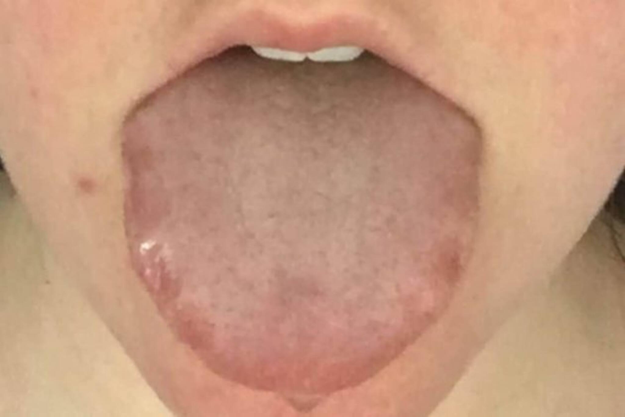 জিভে সাদা আস্তরণ, জ্বালা ভাব; করোনা-রোগীদের নতুন এই উপসর্গ