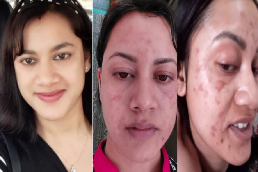 এরপরে তাঁর মুখে একাধিক পোড়া দাগ হয়ে যায়৷ দাগ ও ক্ষত এতটাই গভীর ছিল যে তাঁকে চিকিৎসকদের কাছে যেতে হয়৷ নাথ বলেন, ‘চিকিৎসকরা জানিয়েছেন এগুলো সব পোড়ার দাগ৷ আমি ওষুধ দিচ্ছি, এখন বেশ কিছুটা সময় লাগবে এটা সারতে৷ ’ এরপরে তাঁর মুখে একাধিক পোড়া দাগ হয়ে যায়৷ দাগ ও ক্ষত এতটাই গভীর ছিল যে তাঁকে চিকিৎসকদের কাছে যেতে হয়৷ নাথ বলেন, ‘চিকিৎসকরা জানিয়েছেন এগুলো সব পোড়ার দাগ৷ আমি ওষুধ দিচ্ছি, এখন বেশ কিছুটা সময় লাগবে এটা সারতে৷ ’